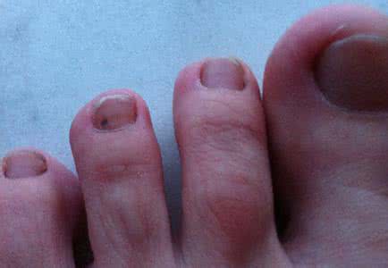 黑色素瘤病因 什么是黑色素瘤?黑色素瘤的病因