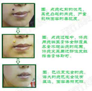 扁平疣和老年斑区别 扁平疣和老年斑区别 如何区别老年斑和扁平疣