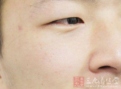 脸部皮肤过敏症状图片 脸部过敏症状 这些表现就是脸部过敏