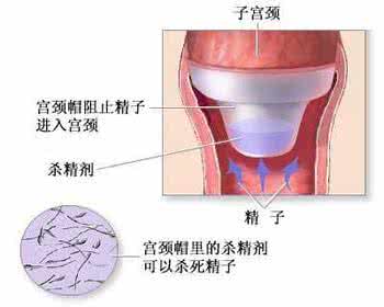 皮下埋植避孕法 阴道隔膜避孕法