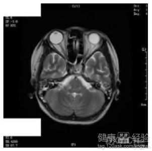 病毒性脑炎后遗症 病毒性脑炎后遗症 病毒性脑炎的后遗症 有哪些症状