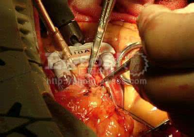 心脏搭桥大夫失业真假 【转载】心脏搭桥大夫要失业了