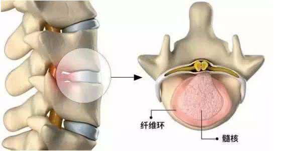 腰椎间盘突出患者 为什么说腰椎间盘突出难治愈? 绝大部分患者都用错了方法!
