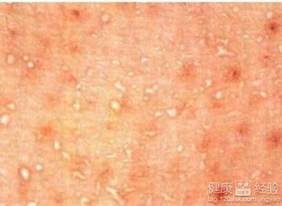 热痱子的治疗方法 热痱子怎么治 治疗热痱子的6个方法