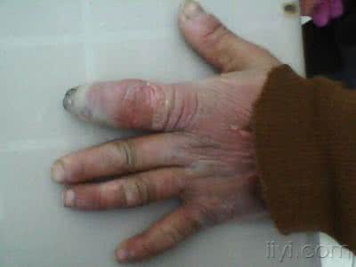 化脓性指头炎 脓性指头炎 它的症状是什么