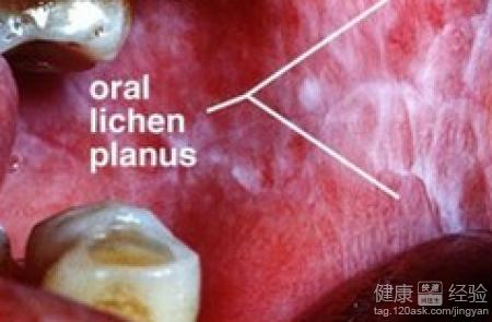 口腔扁平苔藓 丁素先导赤泻心汤治疗顽固性口腔扁平苔藓验案