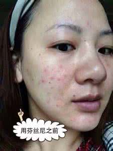 如何快速消除额头痘痘 怎样去掉额头上的痘痘