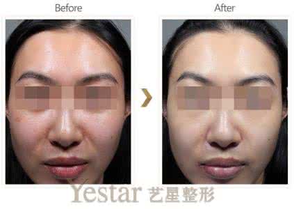 做光子嫩肤怎么样 光子嫩肤怎么做 光子嫩肤怎么做