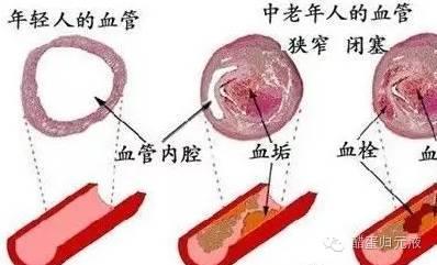 血管毒素 血管毒素 血管里的毒素怎么办？此物将其化解于无形