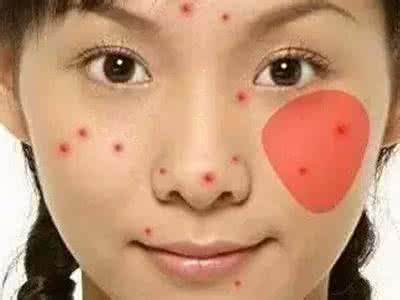 脸上长痘痘位置原因 脸上不同位置长痘痘 脸上不同位置长痘痘的原因