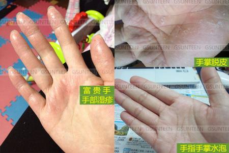 脚后跟干裂起硬皮妙招 治疗脚后跟干裂小妙招 脚干脚裂怎么办 防治手脚干裂的小妙招