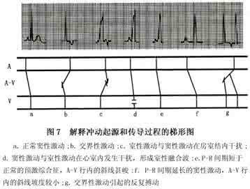 心律失常药物应用总结 应用梯形图分析心律失常
