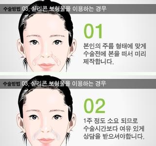 额头整形术 额头整形术 额头整形的两种方法