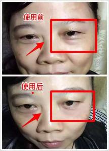 美带三分钟眼袋 骗局 眼袋不是“袋” 不用天天带