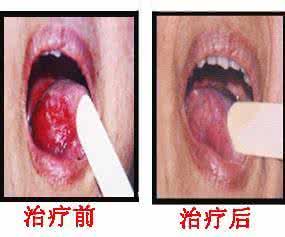 得了口腔癌有什么症状 口腔癌有什么症状 口腔癌的常见症状有哪些