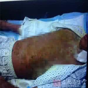 湿疹溃烂可以敷中药吗 小伙患病乱吃中药全身溃烂 每天脱一簸箕皮