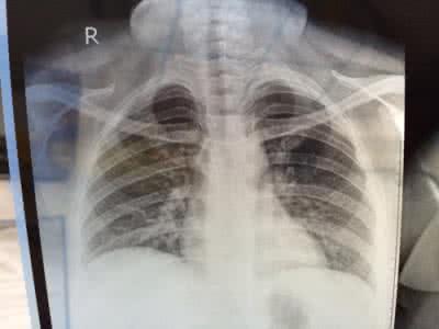 肺部感染的症状 肺部感染的症状 这些症状就是肺部感染