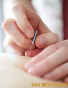 民间针灸高手 记住这些,你也是针灸“高手”!