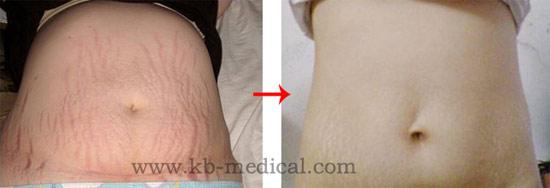 腿上的妊娠纹能去除吗 女性妊娠纹长在腿上该如何去除?