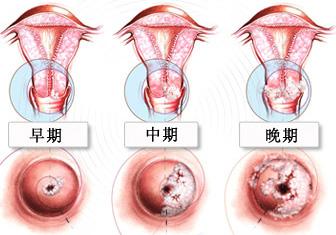 宫颈癌早期症状有哪些 宫颈癌早期症状有哪些 宫颈癌的原因