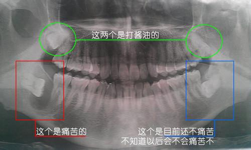 智齿拔掉后有个洞 智齿拔掉后有个洞 女人这洞里的毛可以拔掉吗