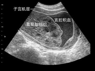 葡萄胎是什么 葡萄胎是什么呢