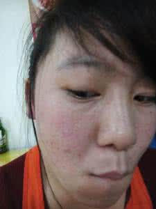 脸上长痘痘是什么原因 脸上有痘痘怎么办?脸上长痘痘的原因?