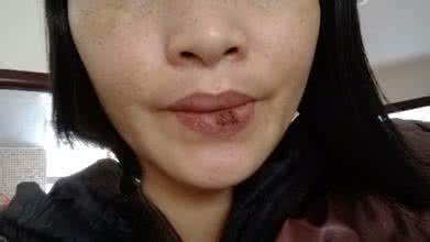 龟头溃疡的治疗方法 口角溃疡的治疗方法 口角溃疡治疗方法