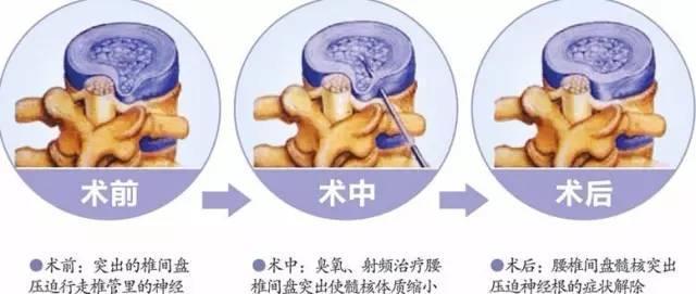 腰椎间盘突出能自愈吗 腰椎间盘突出的治疗方法