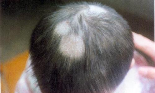 头皮脂溢性皮炎症状 头皮脂溢性皮炎症状 治疗头皮脂溢性皮炎