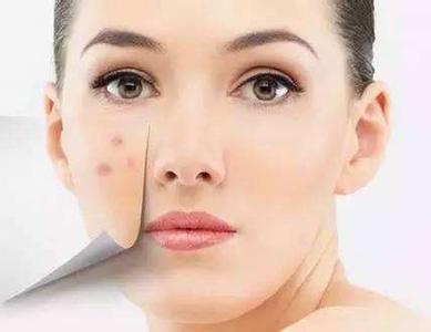 什么面膜去痘印效果好 什么水果做面膜去痘印呢