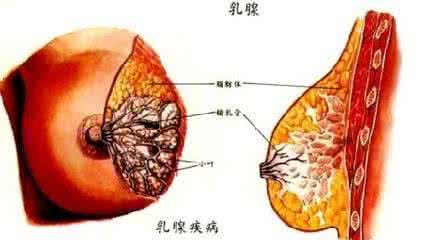 乳腺纤维囊性增生病 乳腺囊性增生 乳腺纤维囊性增生病