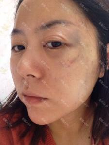 脸上淤青怎么快速消除 脸上淤青可以吃螃蟹么？