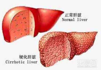 肝硬化可以治愈吗 肝硬化可以治愈吗 正确看待肝硬化 肝硬化可以治愈吗？