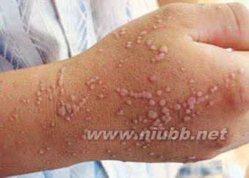 大蒜治疗扁平疣 大蒜治疗扁平疣 大蒜的作用 大蒜怎么治疗扁平疣?