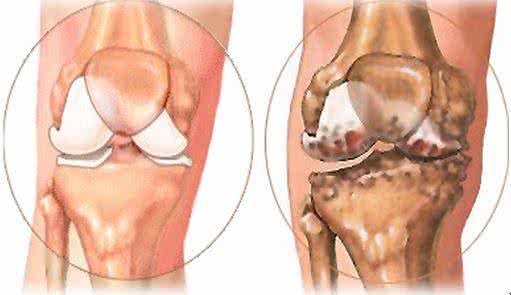 治疗膝关节骨性关节炎 中医药治疗膝关节骨性关节炎
