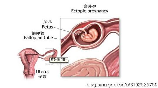 宫外孕早期症状 宫外孕早期症状 宫外孕的食疗方法