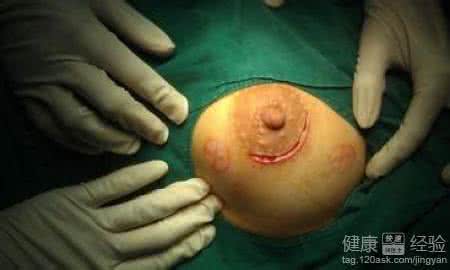 女性不孕的临床症状 乳腺纤维瘤的临床症状 乳腺纤维瘤症状 临床症状有哪些?