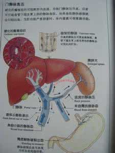 肝硬化失代偿期 肝硬化失代偿期 什么是肝硬化失代偿期