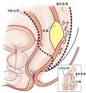 局部进展期直肠癌 局部晚期直肠癌新辅助治疗 新方案安全有效