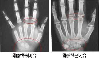 如何判断骨骼是否闭合 如何判断骨骼闭合呢