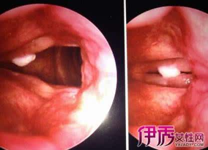 咽喉癌症状及表现 咽喉癌的症状 咽喉癌有哪些表现