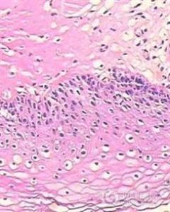 假性尖锐湿疣 假性尖锐湿疣的治疗