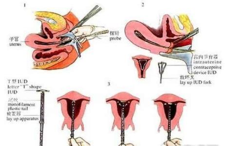 带环后应该注意什么 带环前后应该注意什么呢？