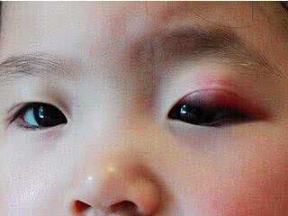 麦粒肿热敷 治疗外麦粒肿的有效方法：贴敷疗法