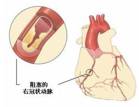 三大致死性心血管疾病 多吃这种食物可降低心血管疾病致死率