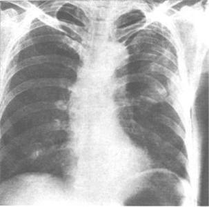 肋骨骨折手术费用 肋骨骨裂 它是通过什么引起的