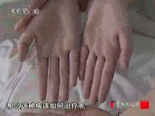 多汗症症状有哪些 多汗症 你了解多汗症是什么症状吗