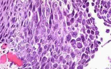 治复发性生殖疱疹方法 生殖疱疹 生殖性疱疹