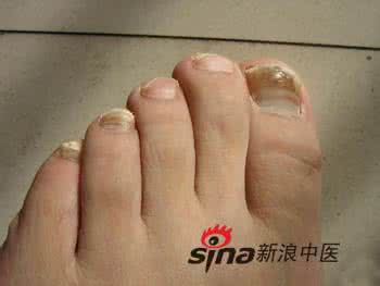 脚趾甲涂什么颜色好看 脚趾甲和健康关系密切脚趾甲变颜色要当心